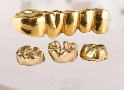 Zahngold Ankauf in der Nähe